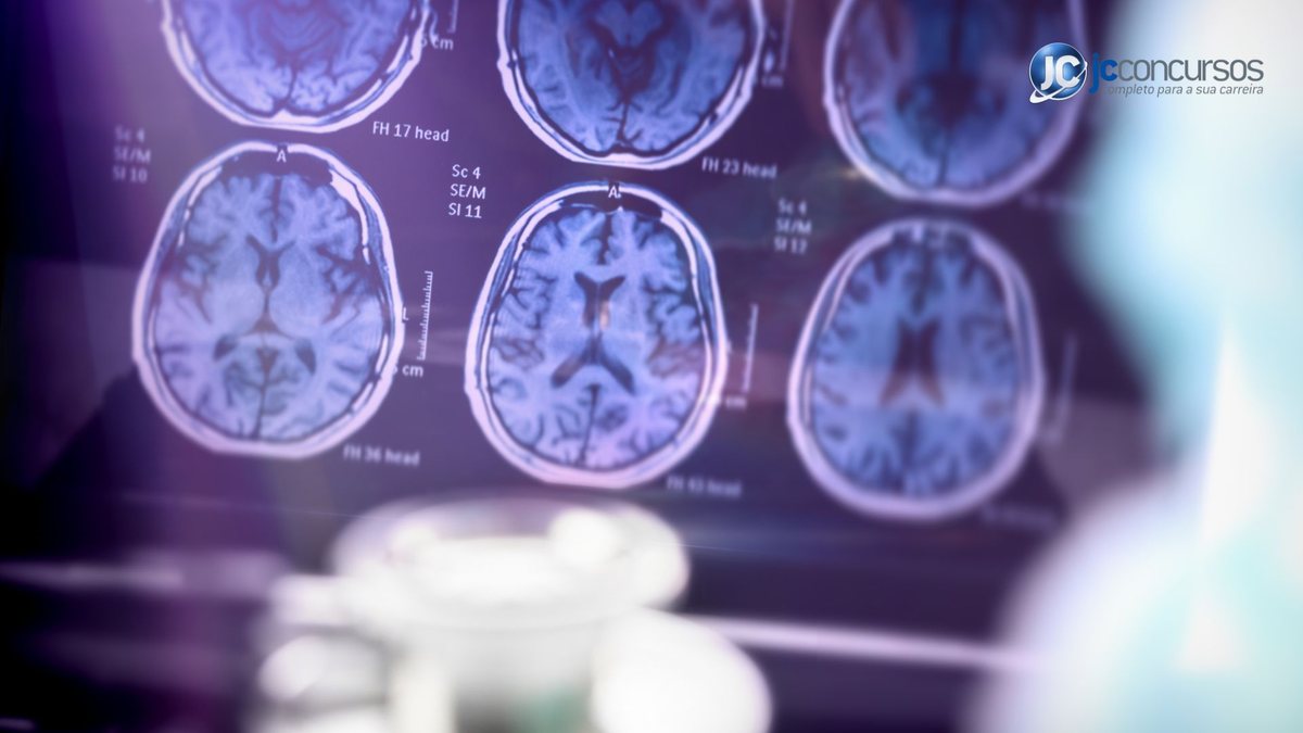 Os studos de fase 2 não haviam mostrado potencial do medicamento para retardar o Alzheimer