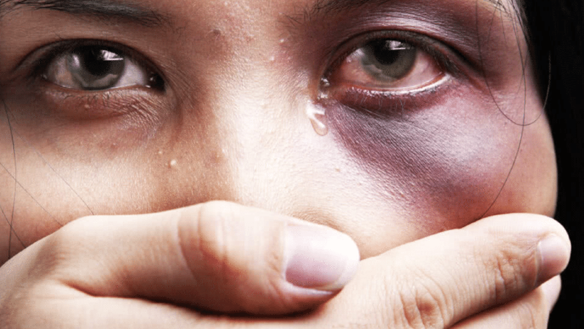 Leis que protegem mulher: mulher com o olho roxo