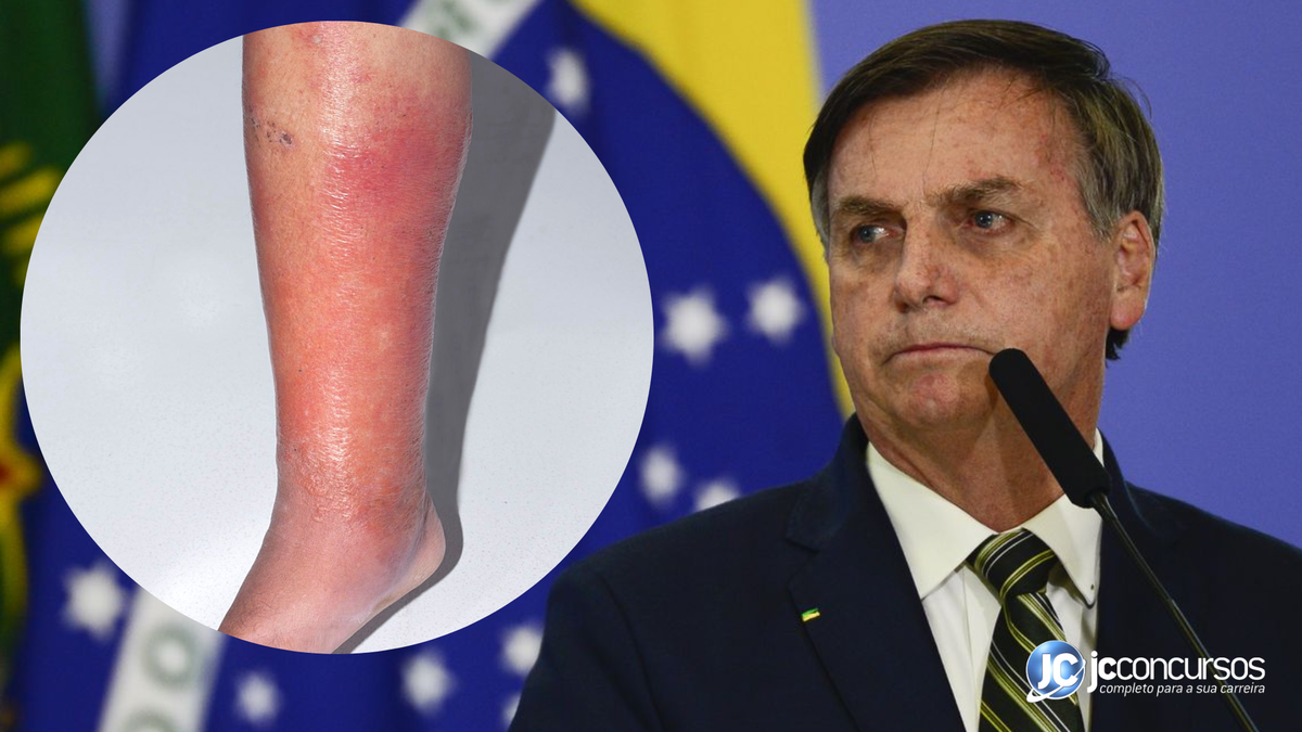 Foto de Jair Bolsonaro junto à imagem de perna afetada por erisipela