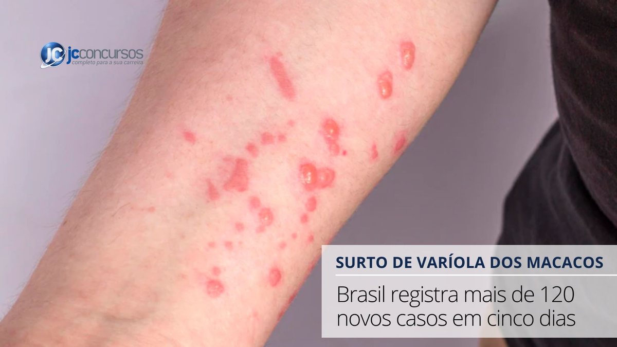 Pessoa com lesões no braço em decorrência da contaminação pelo vírus da varíola dos macacos | Foto: Freepik