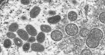 O primeiro caso da varíola do macaco na América Latina foi confirmado na Argentina nesta segunda-feira (23) - Centro de Controle de Doenças/Divulgação