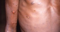 Varíola dos macacos: homem infectado com erupções cutâneas - Divulgação/Agência Brasil
